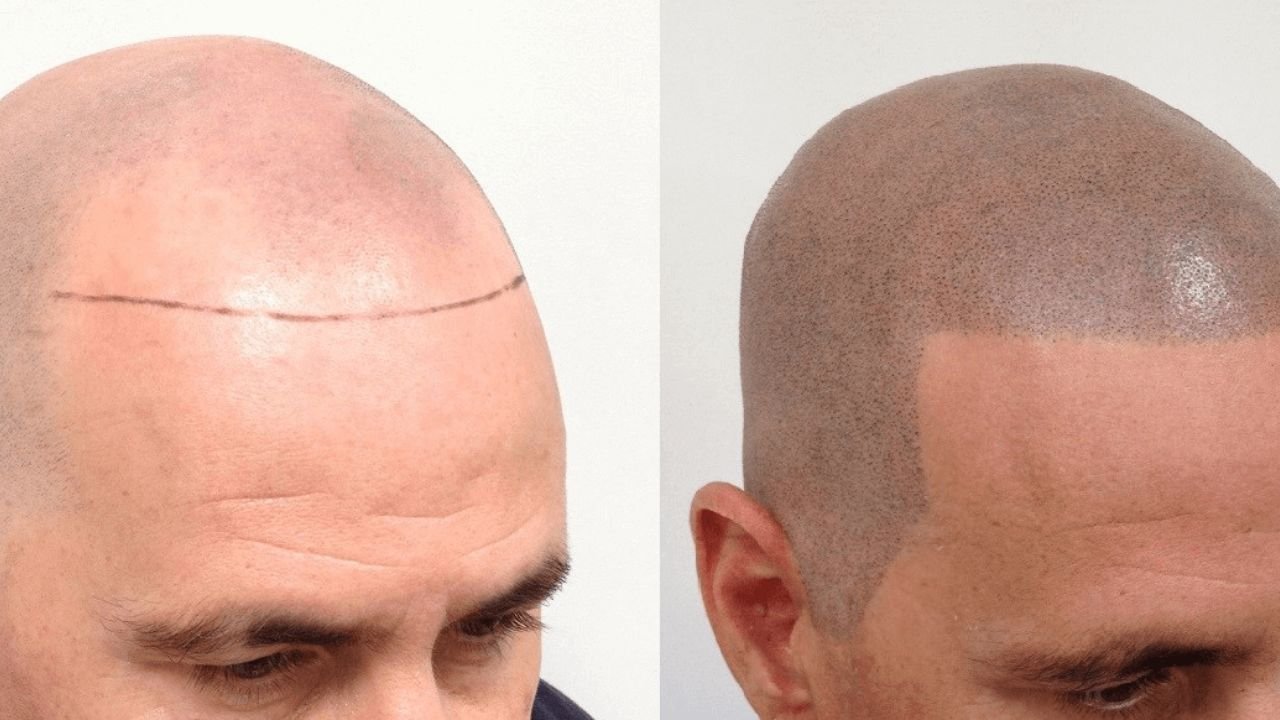 Best hair transplant clinic bhopal